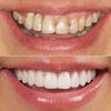 SparkleTooth™ - Teeth whitening pen【Last day discount】