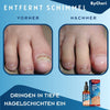 ToePerfect™ - Heals toenails and hangnails [last day discount]