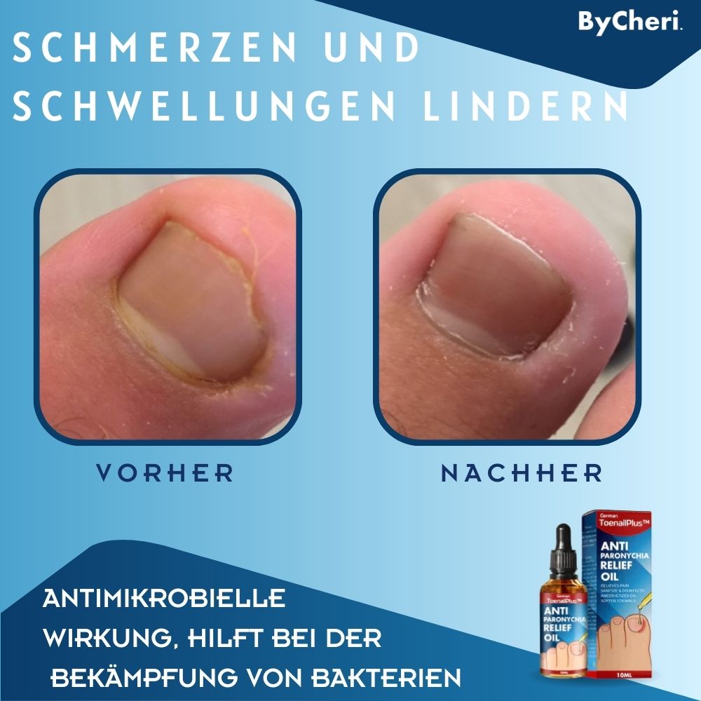 ToePerfect™ - Heals toenails and hangnails [last day discount]