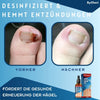 ToePerfect™ - Heals toenails and hangnails [last day discount]