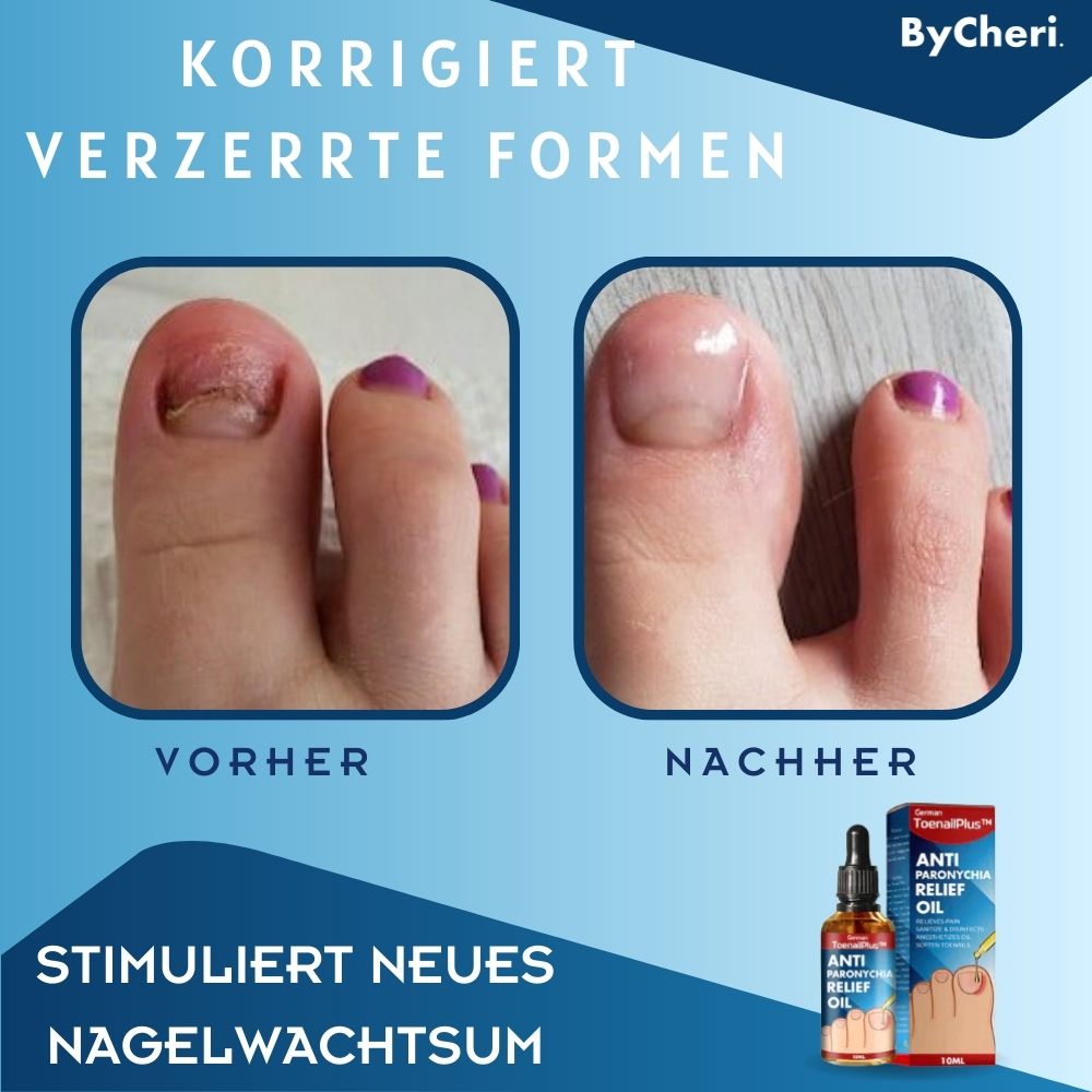 ToePerfect™ - Heals toenails and hangnails [last day discount]