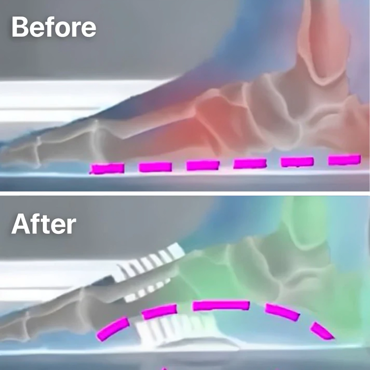 StepRelief™ | Orthopedic foot arch support