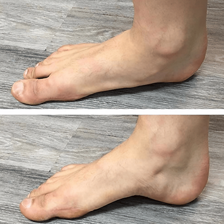 StepRelief™ | Orthopedic foot arch support