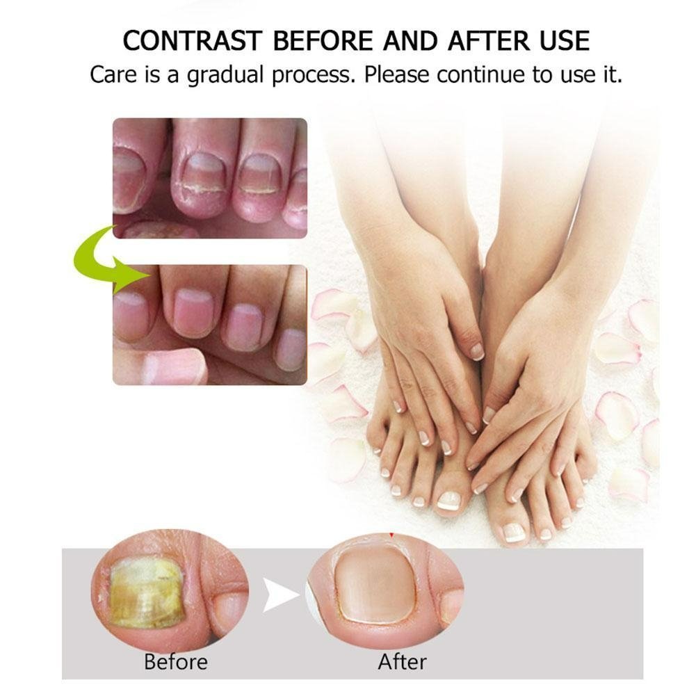 Nail Repair™ - Fast and effective results!