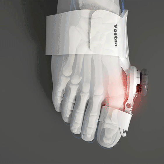 BOOnion™ - Orthopaedic bunion correction hallux valgus for pain relief [last day discount]